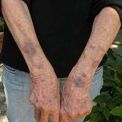 Arnica Bruise Cream Best NZ Arnica Cream for reducing bumps and bruises after blood tests or falls for kids or unsightly bruises on thin elderly skin. natural pain relief reduces swelling and speeds healing